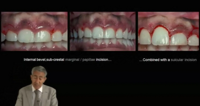 Crown Lengthening - Achieving Esthetic Predictability in Periodontology 2 Crown Lengthening - Achieving Esthetic Predictability in Periodontology - Image 2