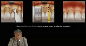 Crown Lengthening - Achieving Esthetic Predictability in Periodontology 3 Crown Lengthening - Achieving Esthetic Predictability in Periodontology - Image 3