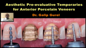 Aesthetic Pre-evaluative Temporaries for Anterior Porcelain Veneers