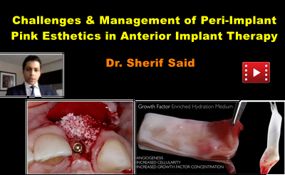 Challenges & Management of Peri-Implant Pink Esthetics in Anterior Implant Therapy 1 Challenges & Management of Peri-Implant Pink Esthetics in Anterior Implant Therapy