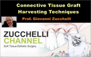 Connective Tissue Graft Harvesting Techniques (Giovanni Zucchelli)