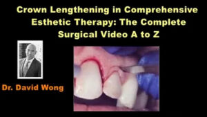 Crown Lengthening in Comprehensive Esthetic Therapy