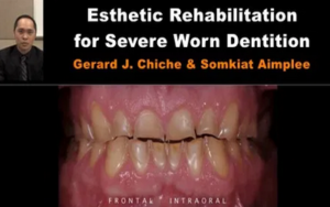 Esthetic Rehabilitation for Severe Worn Dentition