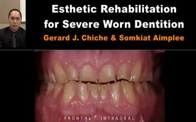 Esthetic Rehabilitation for Severe Worn Dentition 1 Esthetic Rehabilitation for Severe Worn Dentition