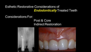 Esthetic Restorative Considerations of Endodontically Treated Teeth