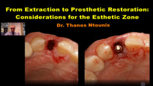 From Extraction to Prosthetic Restoration