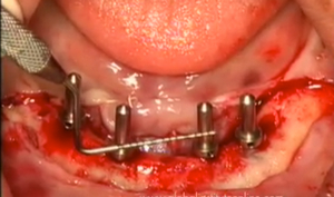 Immediate Implants Techniques (3 Videos) 2 Immediate Implants Techniques