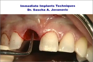Immediate Implants Techniques