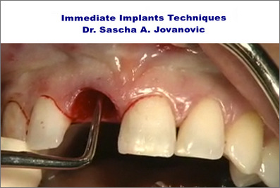 Immediate Implants Techniques (3 Videos) 1 Immediate Implants Techniques