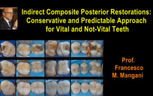 Indirect Composite Posterior Restorations