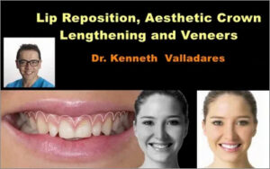 Lip Reposition, Aesthetic Crown Lengthening and Veneers
