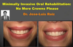 Minimally Invasive Oral Rehabilitation: No More Crowns Please