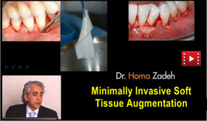 Minimally Invasive Soft Tissue Augmentation