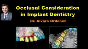 Occlusal Consideration in Implant Dentistry