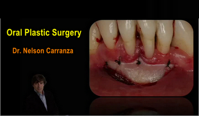 Oral Plastic Surgery (Nelson Carranza) - Dental Videos