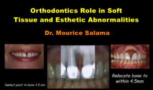Orthodontics Management in Soft Tissue Abnormalities