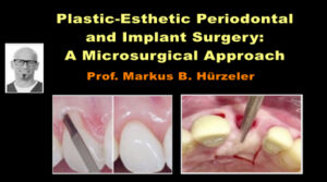 Plastic-Esthetic Periodontal and Implant Surgery: A Microsurgical Approach