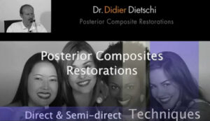 Posterior Composites Restorations: Direct & Semi-Direct Techniques