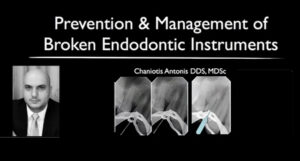 Prevention and Management of Broken Endodontic Instruments
