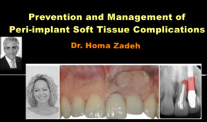 Prevention and Management of Peri-implant Soft Tissue Complications
