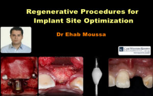 Regenerative Procedures for Implant Site Optimization
