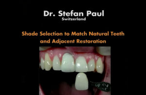 Shade Selection to Match Natural Teeth and Adjacent Restoration