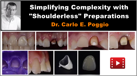 Simplifying Complexity with Shoulderless Preparations 1 Simplifying Complexity with Shoulderless Preparations
