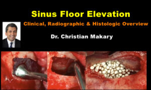 Sinus Floor Elevation: Clinical, Radiographic & Histologic Overview