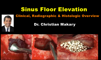 Sinus Floor Elevation: Clinical, Radiographic & Histologic Overview 1 Sinus Floor Elevation: Clinical, Radiographic & Histologic Overview