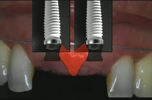 Advanced Implant Therapy: Soft Tissue Management 3 Advanced Implant Therapy: Soft Tissue Management - Image 3