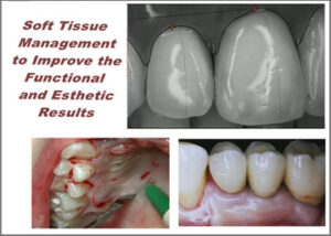 Advanced Implant Therapy - Soft Tissue Management