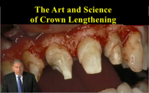 The Art and Science of Crown Lengthening: Surgical Crown Lengthening
