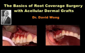 The Basics of Root Coverage Surgery with Acellular Dermal Grafts