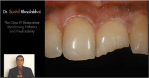 The Class IV Restoration: Maximizing Esthetics and Predictability