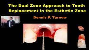 The Dual Zone Approach to Tooth Replacement in the Esthetic Zone