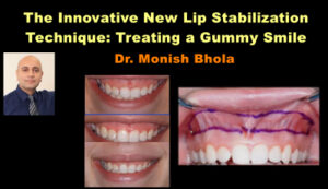 Treating of Gummy Smile: New Lip Stabilization Technique