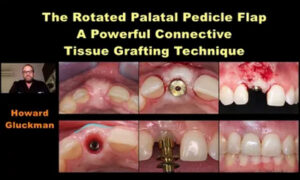 The Rotated Palatal Pedicle Flap