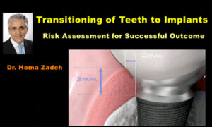 Transitioning of Teeth to Implants: Risk Assessment for Successful Outcome