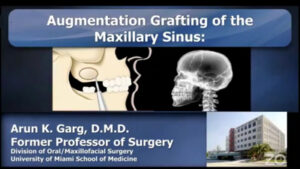 Augmentation Grafting of the Maxillary Sinus