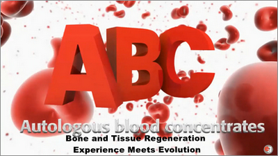 Autologous Blood Concentrates: Bone and Tissue Regeneration Experience Meets Evolution 1 Bone and Tissue Regeneration Experience Meets Evolution