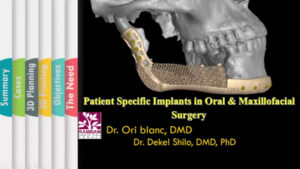 Custom Maxillofacial Implants