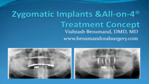 Full Arch Rehabilitation of the Atrophic Maxilla with Zygomatic Implants