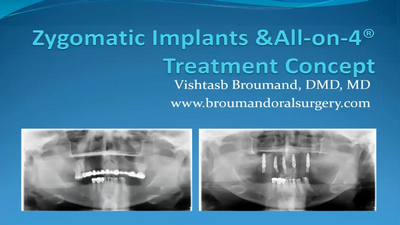 Full Arch Rehabilitation of the Atrophic Maxilla with Zygomatic Implants 1 Full Arch Rehabilitation of the Atrophic Maxilla with Zygomatic Implants