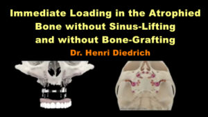 Immediate Loading in the Atrophied Bone without Sinus-Lifting and without Bone-Grafting