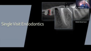 Single Visit Endodontics