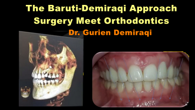 The Baruti-Demiraqi Approach Surgery Meet Orthodontics 1 The Baruti-Demiraqi Approach Surgery Meet Orthodontics