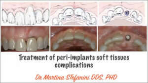 Treatment of Peri-Implant Soft Tissues Complications