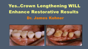 Crown Lengthening WILL Enhance Restorative Results