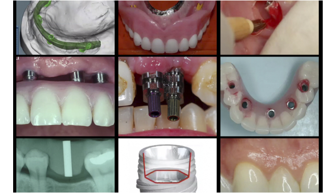 A-Z in Restorative Implant Dentistry Series (16 Lectures) 1 A-Z in Restorative Implant Dentistry Series (16 Lectures)