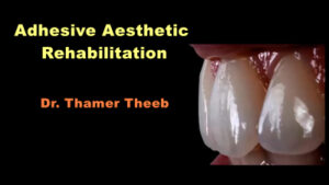 Dental Adhesive Aesthetic Rehabilitation